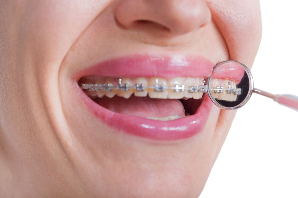 metal braces with a magnifying glass next to patient