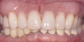 Picture of a teeth after dental procedure