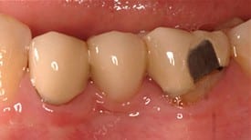 Picture of a teeth before dental procedure