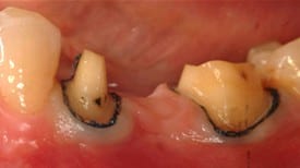 Picture of a teeth before dental procedure