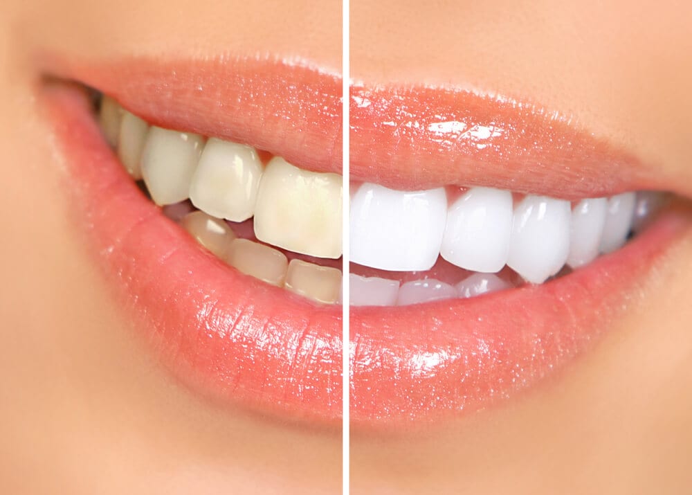 before and after teeth results